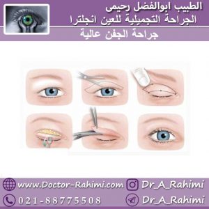 جراحة الجفن عالية