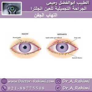 التهاب الجفن