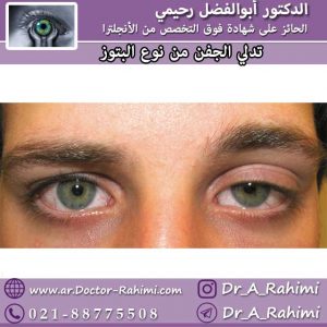تدلي الجفن من نوع البتوز