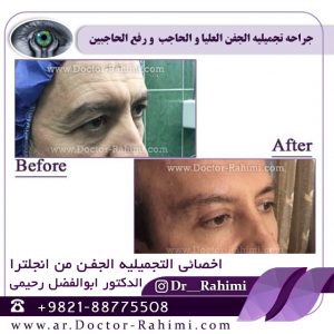 جراحه تجمیلیه الجفن التحتانی