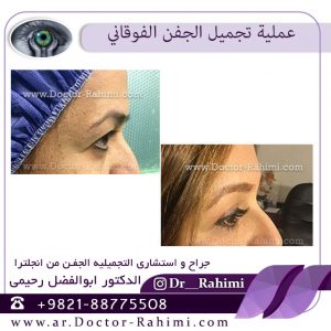 العناية بعد جراحة الجفن