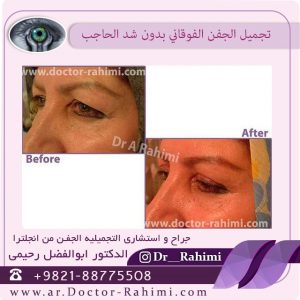 سبب تدلی الجفن من نوع البتوز