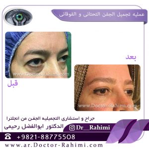 علاج لانتفاخ الجفن السفلي