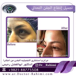 اسئله و اجوبه حول تدلی الجفن