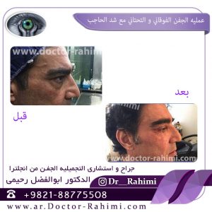 الاختلافات فی نوع الانتفاخ فی الجفن العلیا والحواجب المتدليه