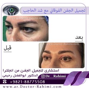 انخفاض التورم بعد راب الجفن