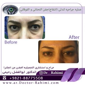 علاج تدلی الجفن الخلقی