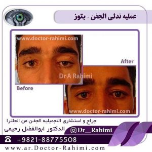 تدلی الجفن من نوع بتوز     