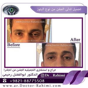 تدلی الجفن من نوع بتوز     