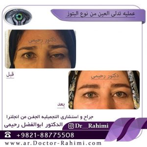 تدلی الجفن من نوع بتوز     