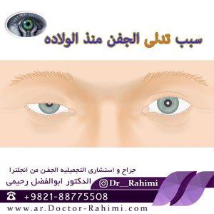 اسئله و الاجوبه حول تدلی الجفن الفوقانی